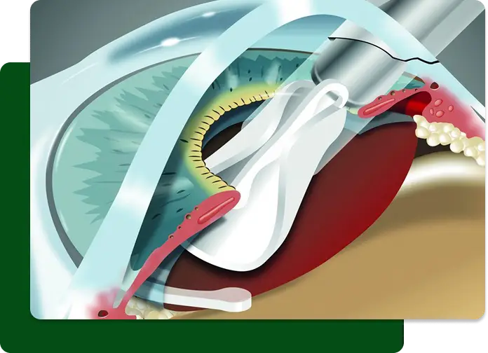 Refraktiver Linsenaustausch in Villingen-Schwenningen